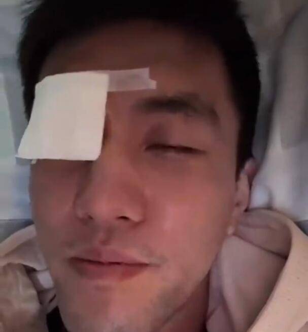 结膜破碎，缝了40多针！ 郭艾伦回忆恐怖受伤过程